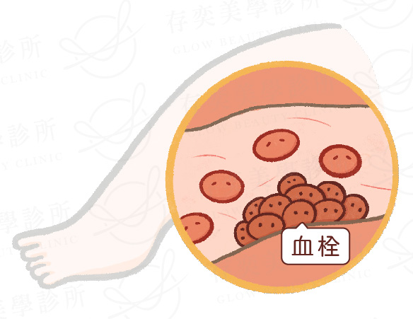 造成血栓的原因v2_血流速度變慢