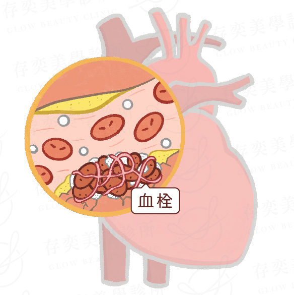 造成血栓的原因v2_血管內壁受損