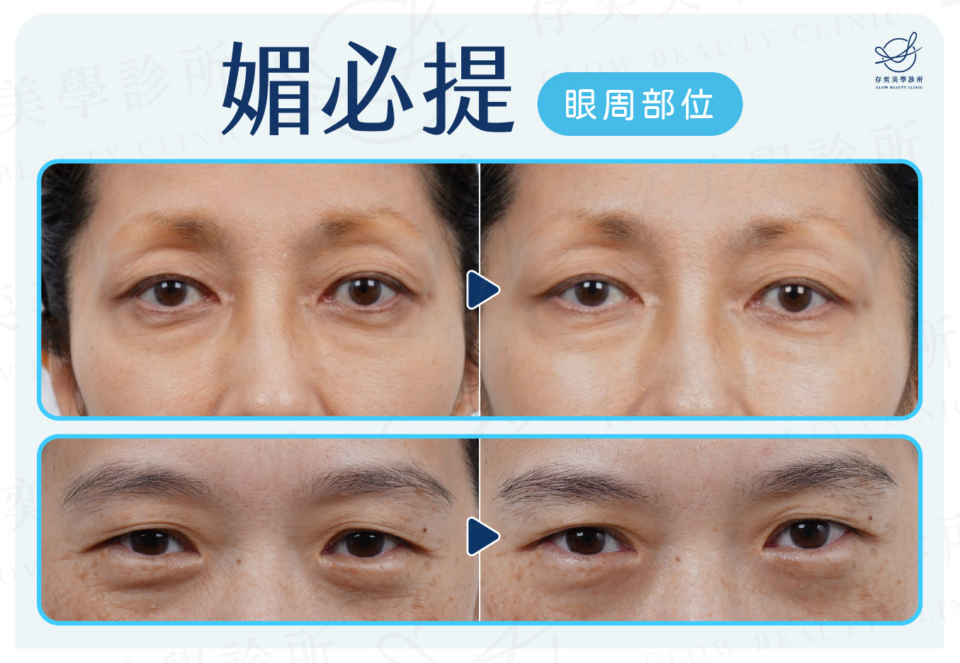 媚必提案例照V3_眼周部位