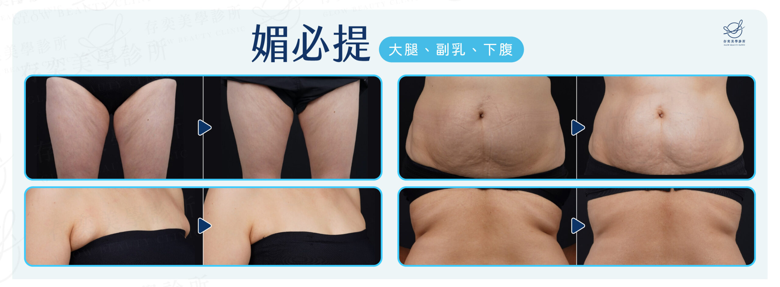 媚必提案例照V6-身體部位 (1)