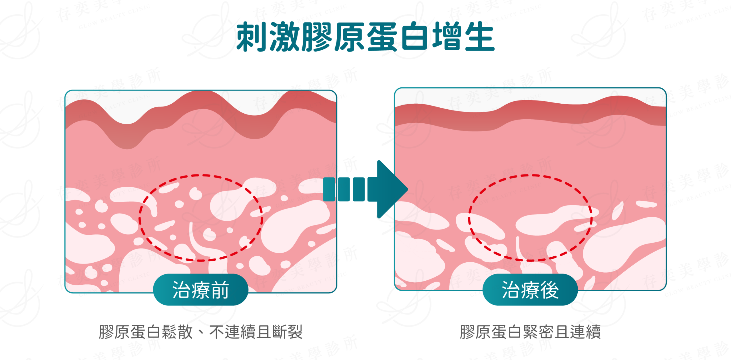 ondapro官網圖_刺激膠原蛋白增生
