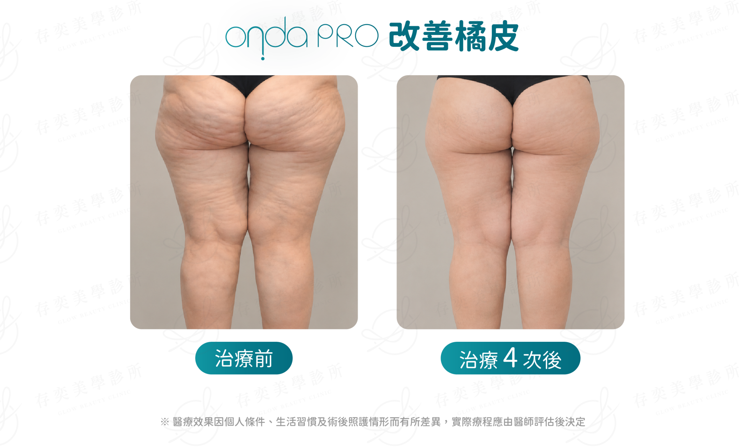 ondapro官網圖_BA照橘皮
