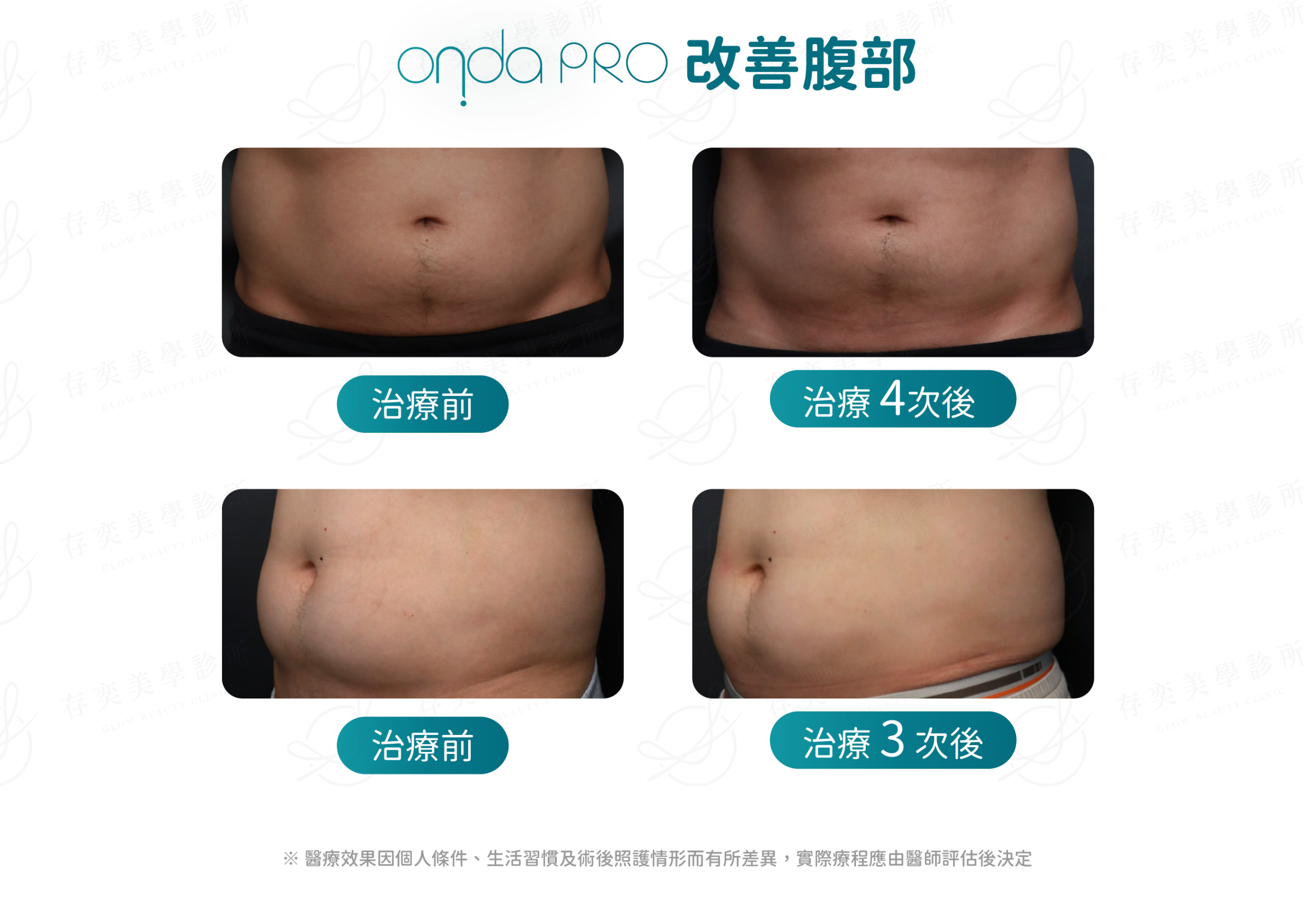 ondapro官網圖_BA照腹部