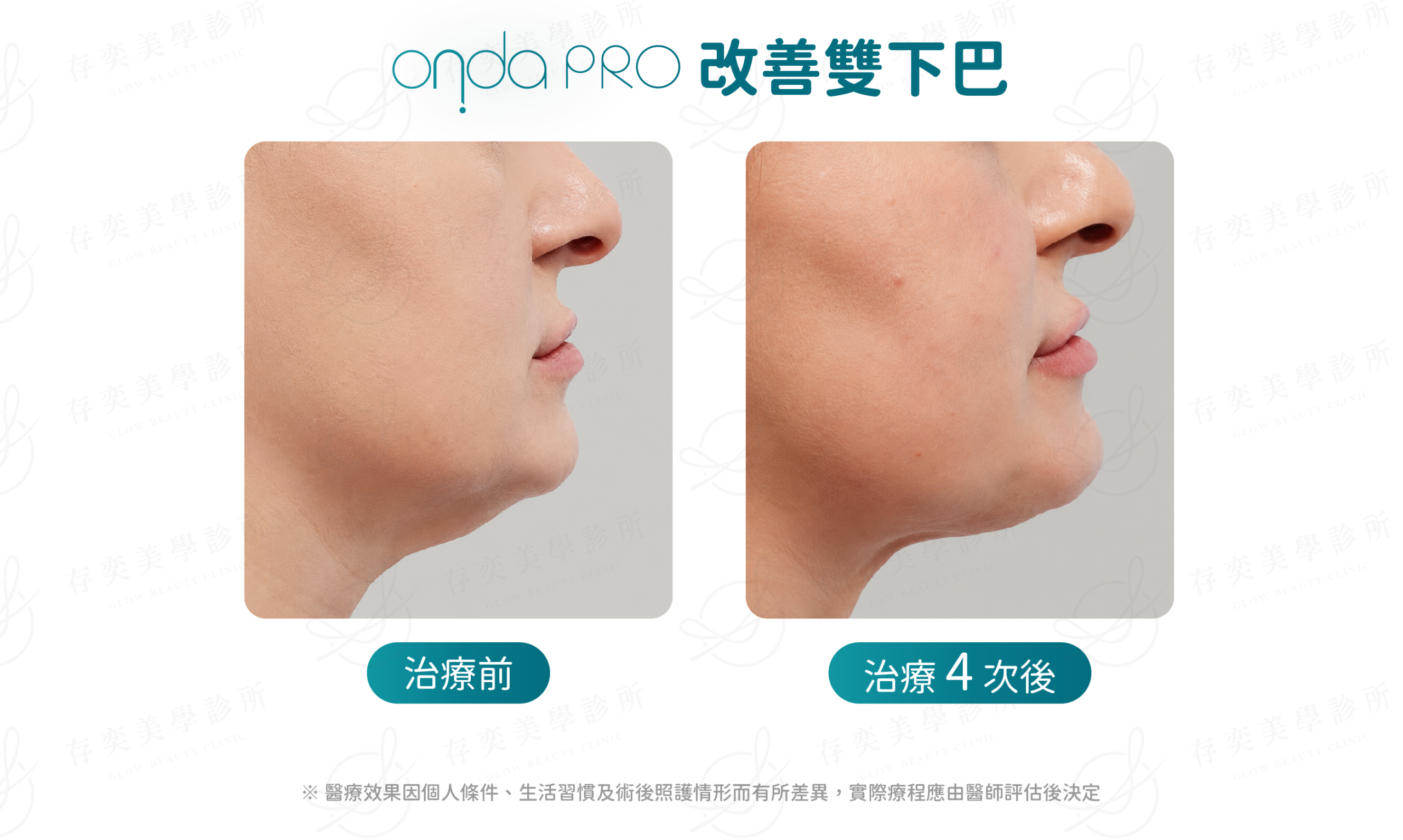 ondapro官網圖_BA照雙下巴