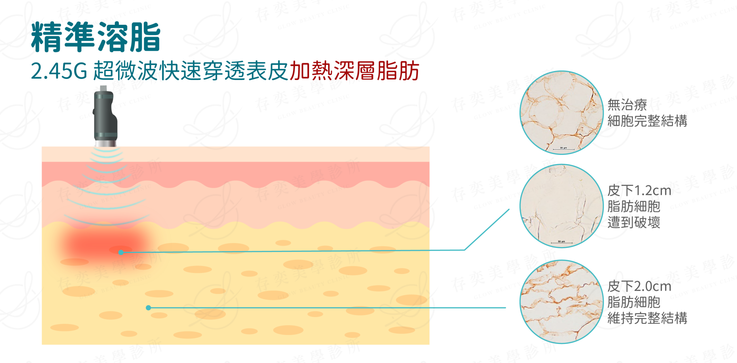 ondapro官網圖_精準溶脂