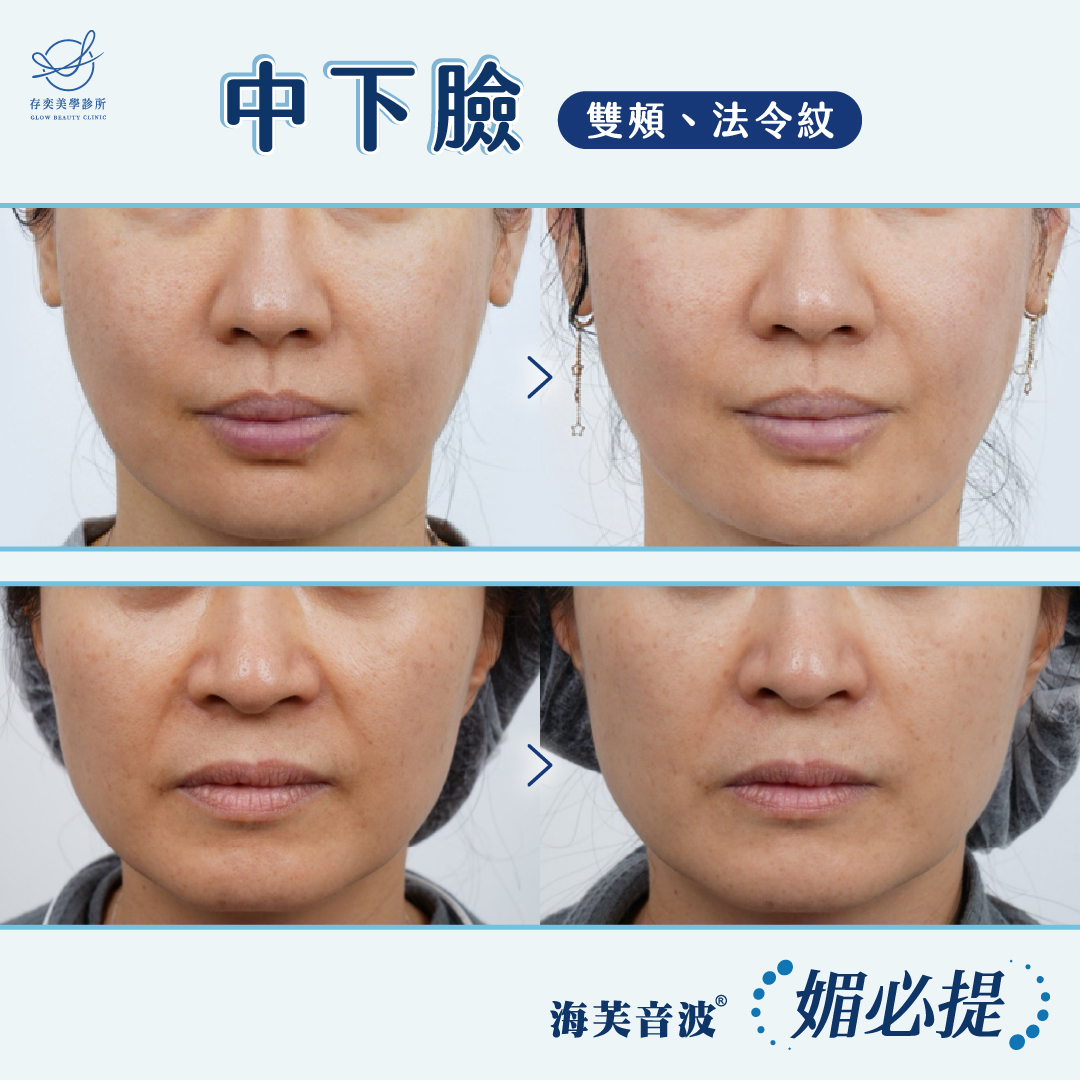 媚必提_中下臉