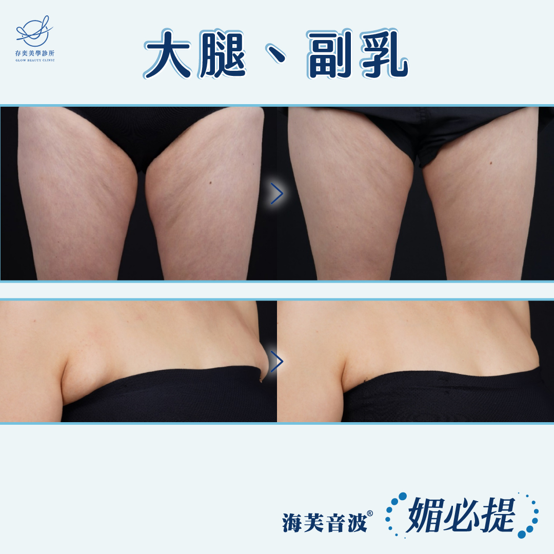 媚必提_大腿、副乳