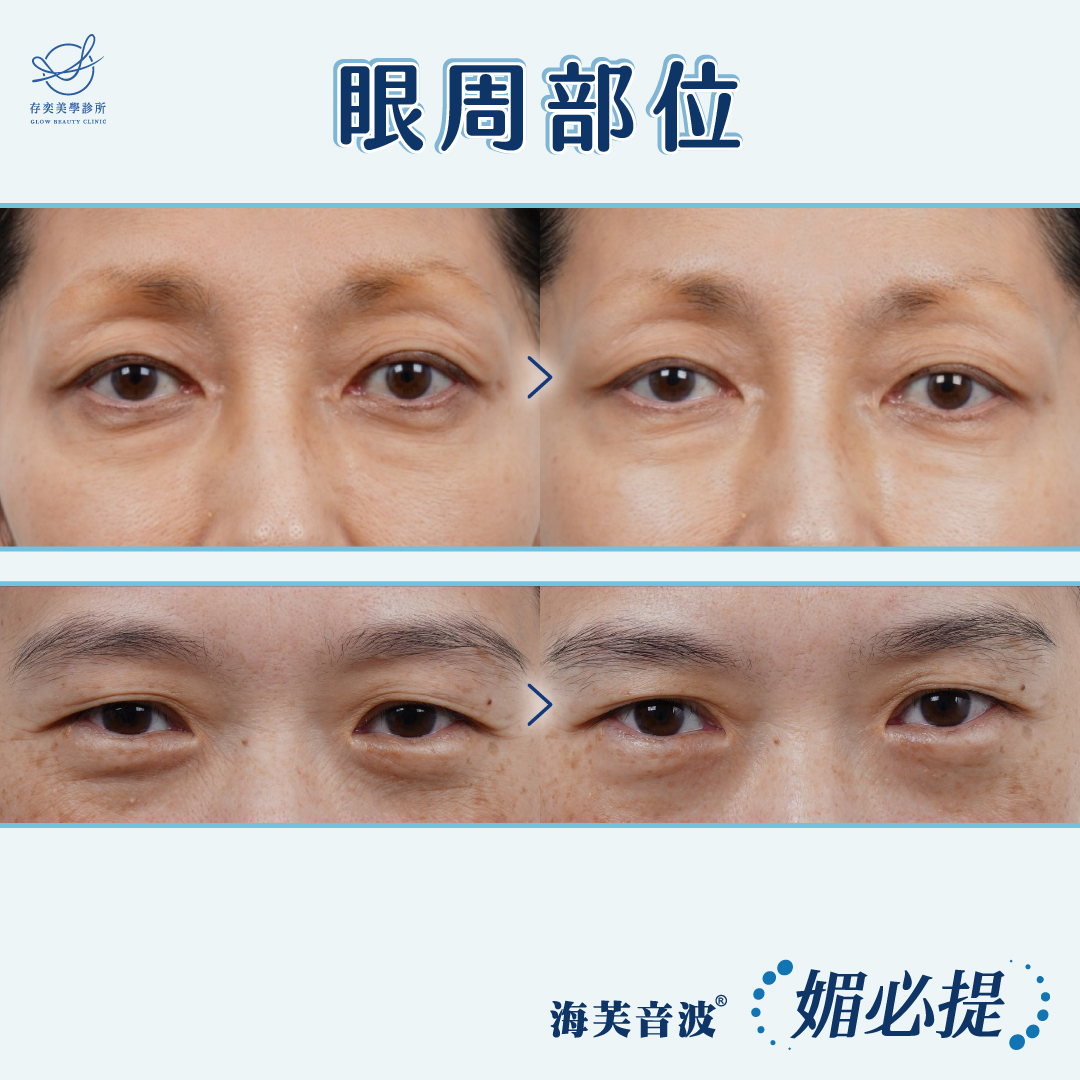 媚必提_眼周部位
