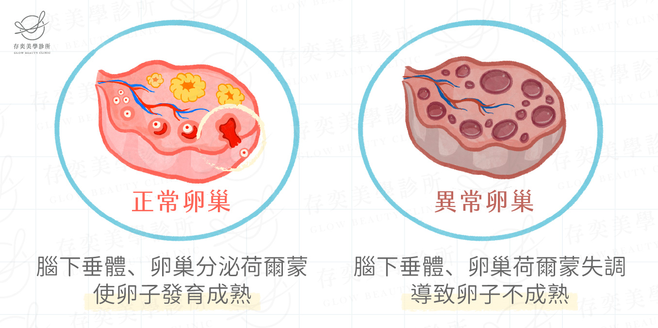 什麼是多重內分泌代謝性卵巢症候群
