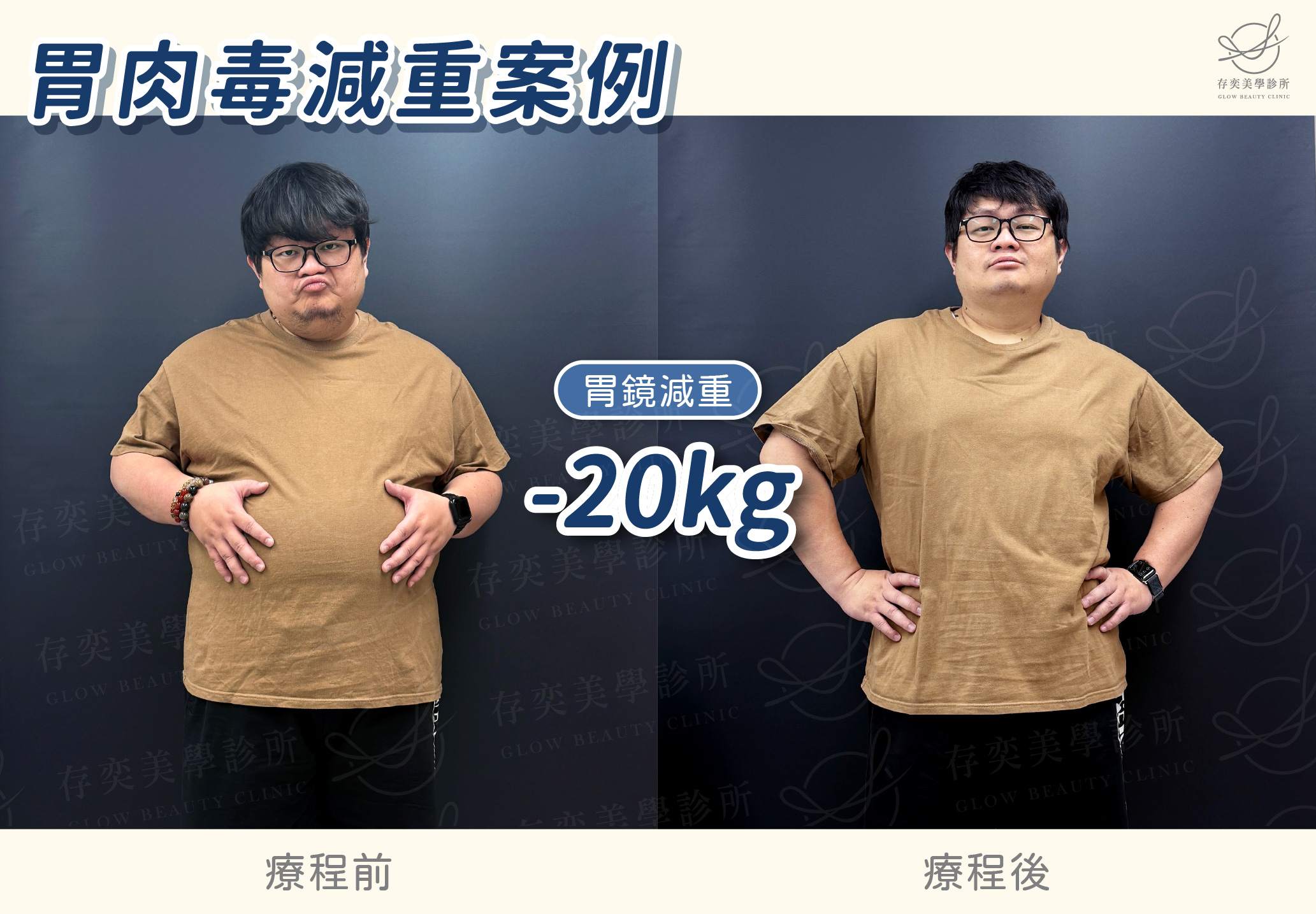 林玟圻減重BA-胃肉毒減20公斤