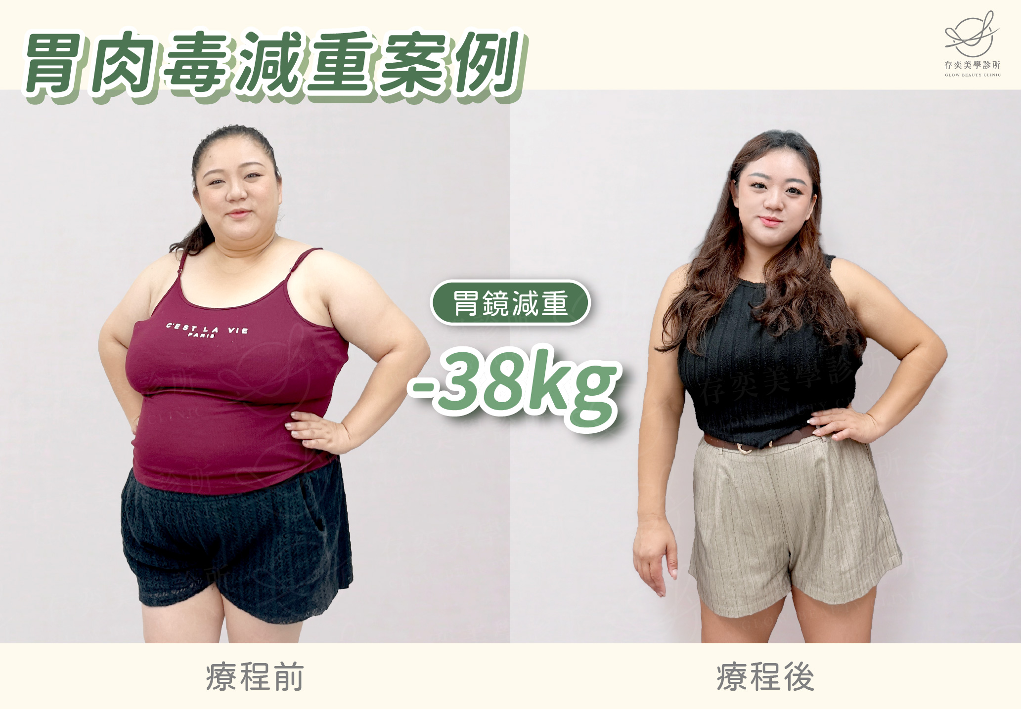 陳雅勤減重BA-胃鏡減重減38公斤