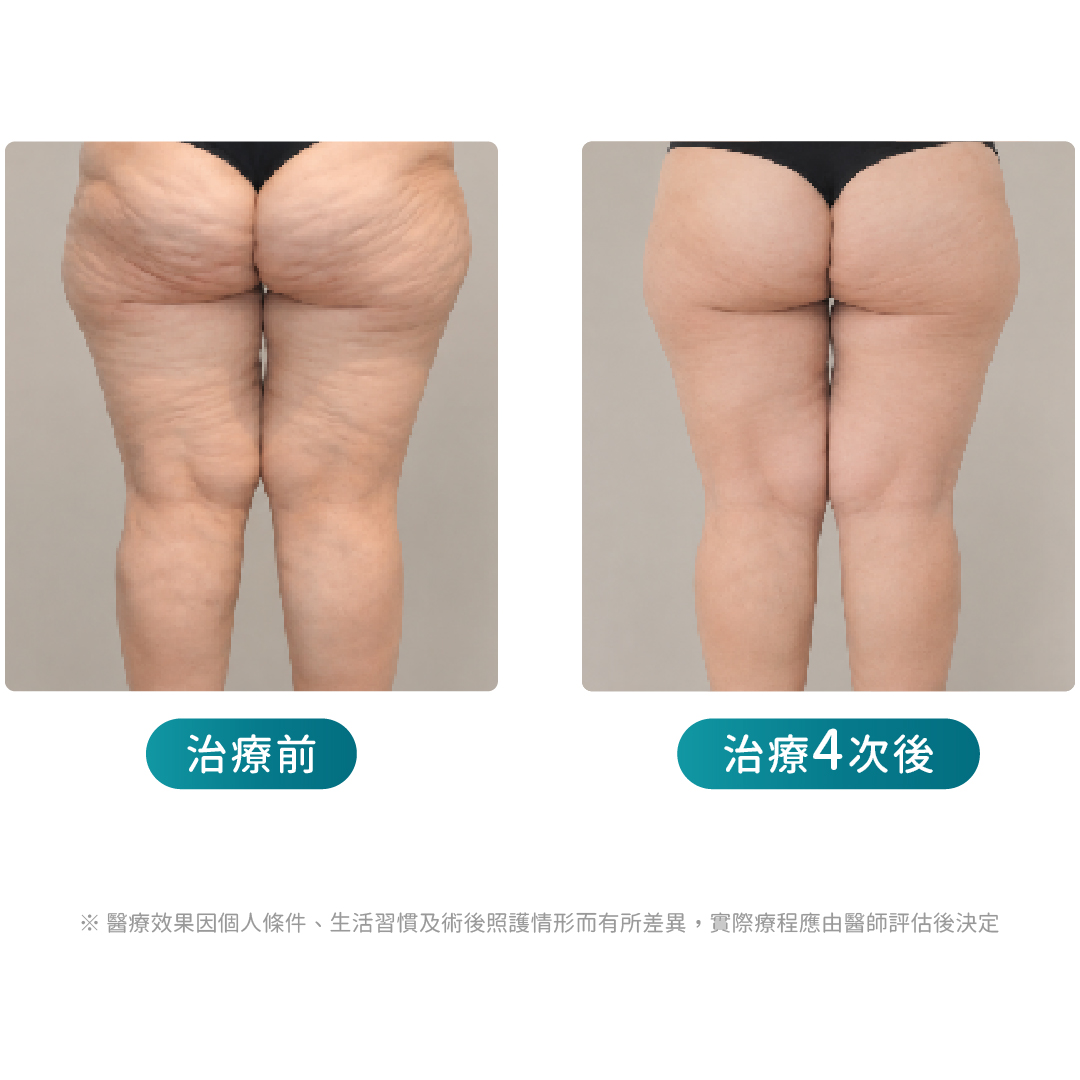 ondapro廣告頁_改善橘皮