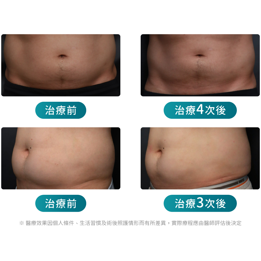 ondapro廣告頁_改善腹部