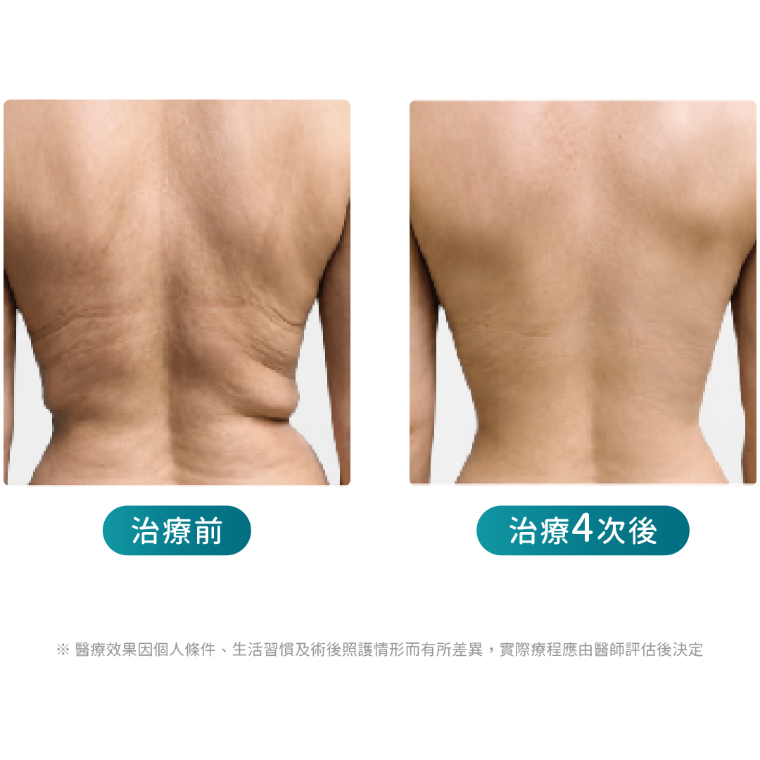 ondapro廣告頁_背部雕塑