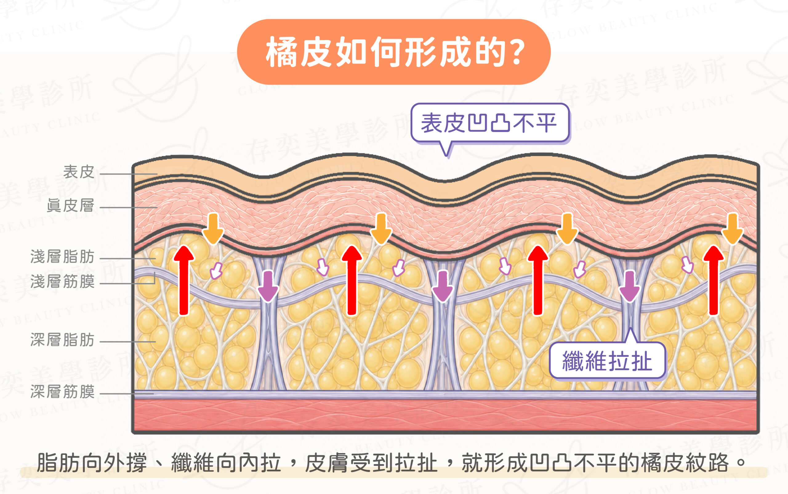 橘皮如何形成的v4