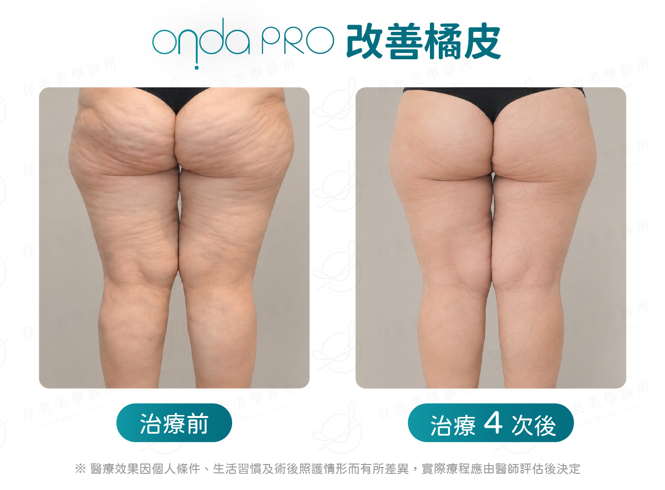 ondapro案例圖_BA照橘皮