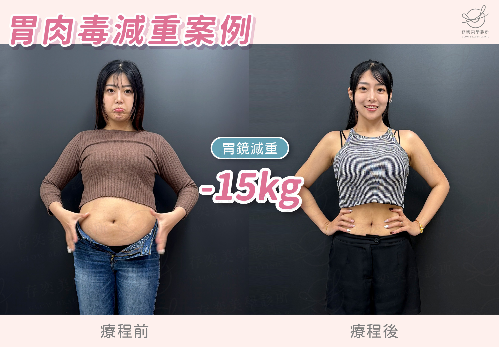 妮妮減重BA-胃鏡減重減15公斤