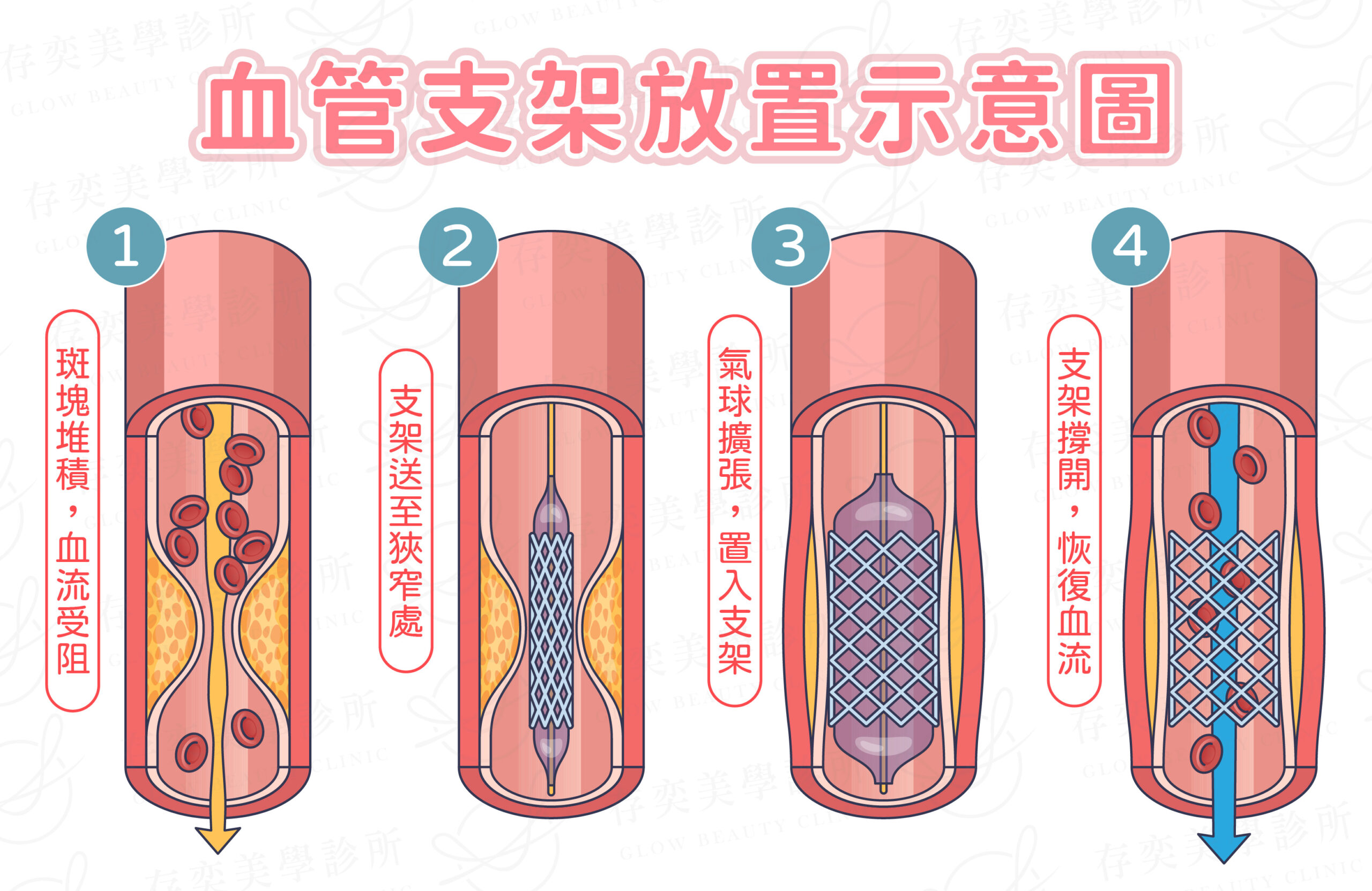 血管支架放置示意圖