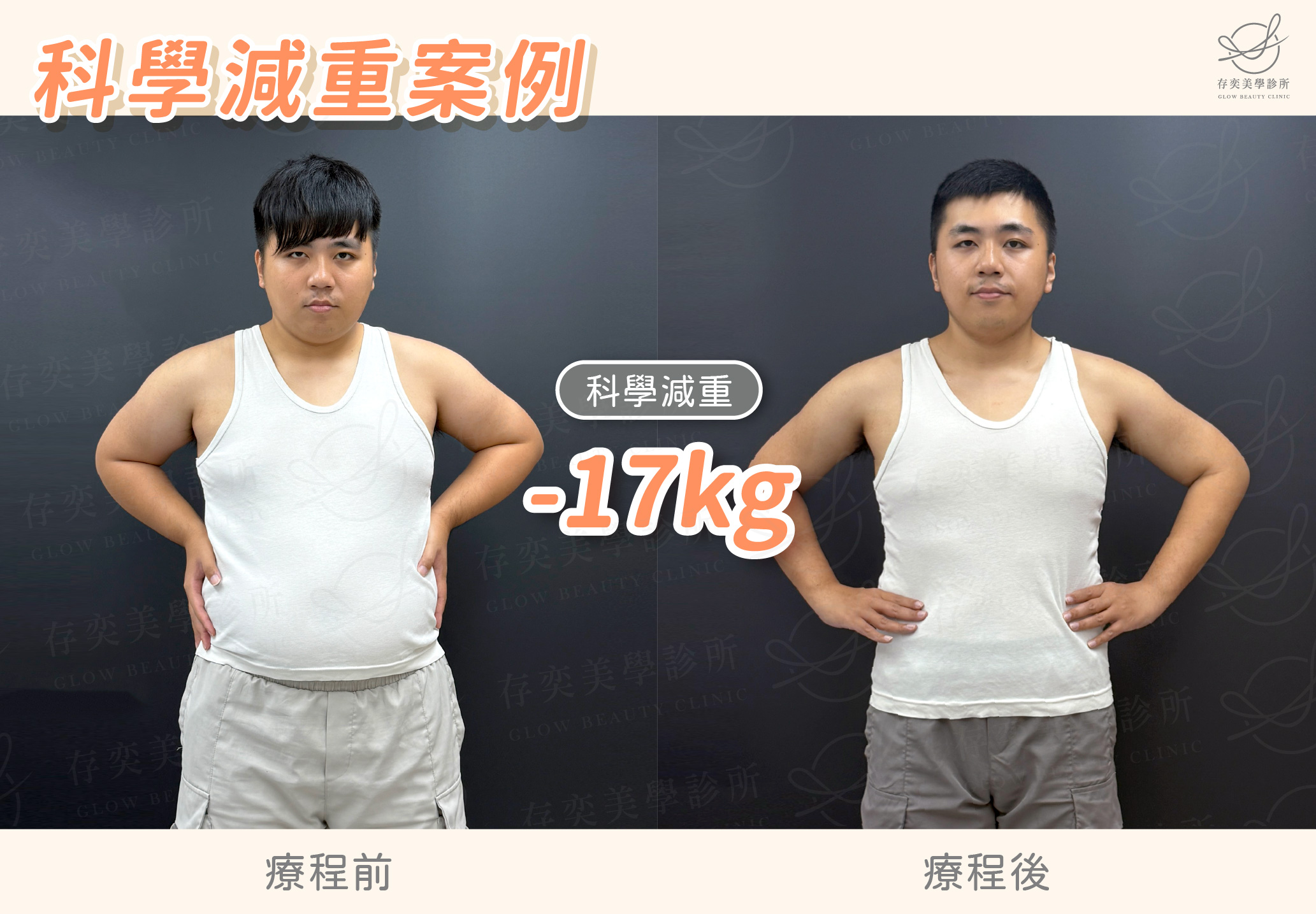 鄭育瑜 減重BA-減重17公斤